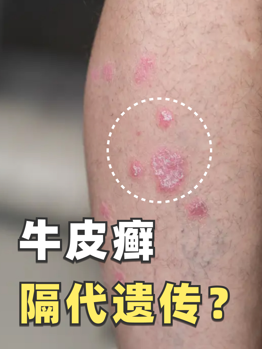 牛皮癣隔代遗传吗？医生来解答！