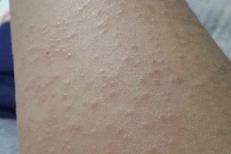 妊娠多形疹疙瘩图 妊娠多形疹疙瘩图