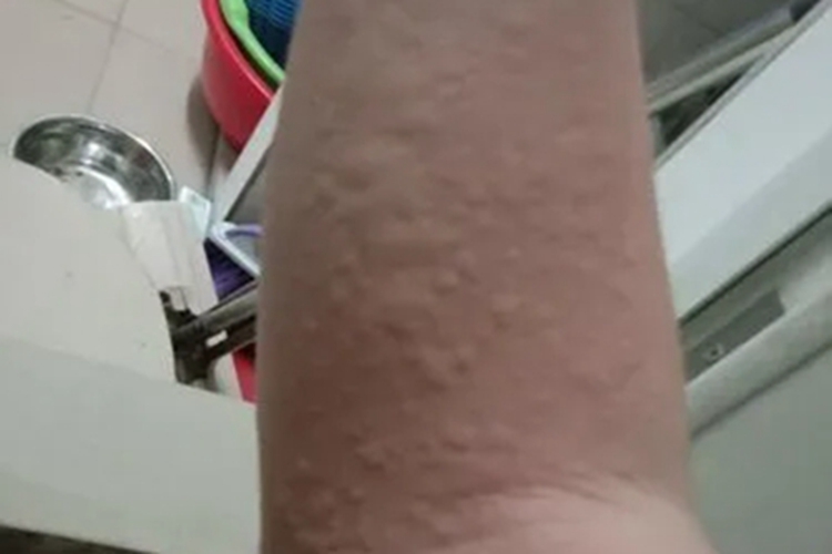 海鲜过敏胳膊长疙瘩图