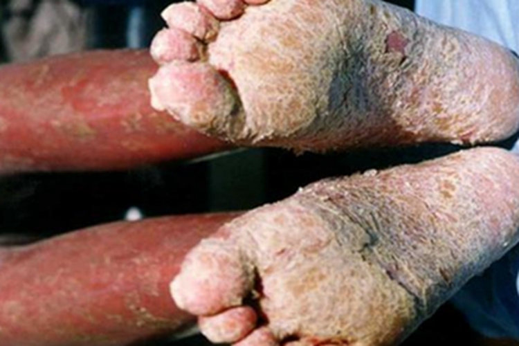 银屑病脚底脱屑图