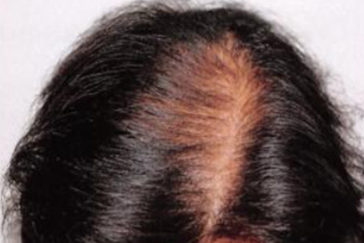 女性脂溢性脱发早期图