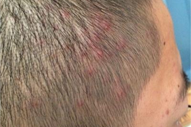 头虱病头皮症状图