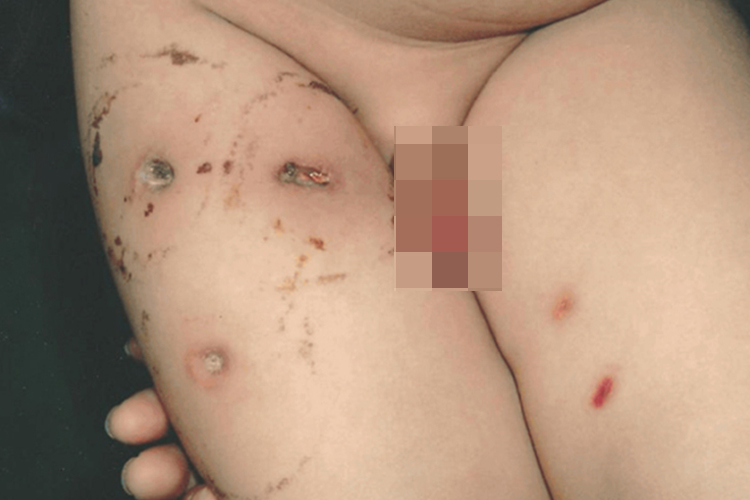 腿部皮肤溃疡图