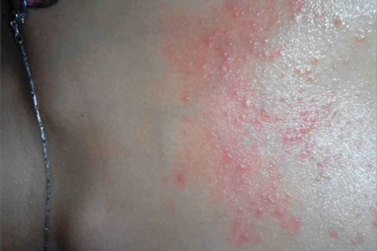 地方性斑疹伤寒胸部红斑图