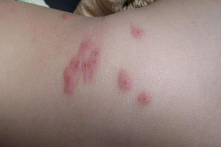 千足虫咬人伤口红肿图 千足虫咬人伤口红肿图