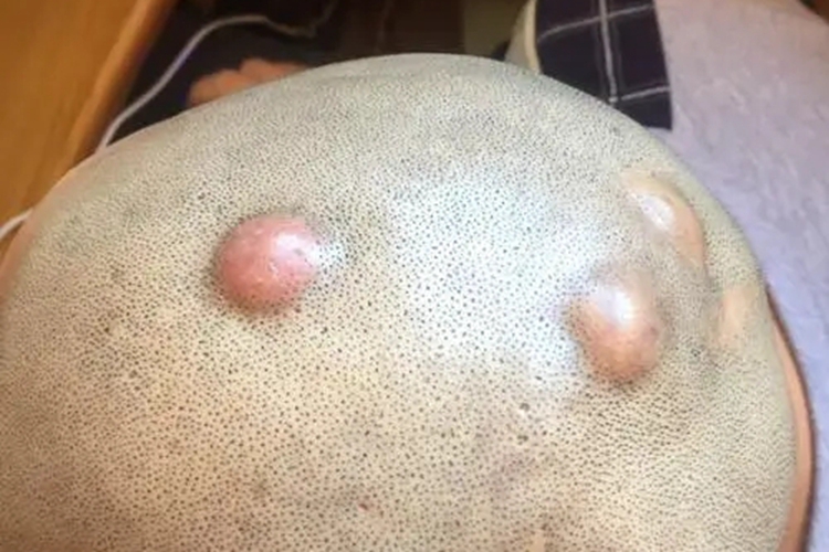 多发性皮脂腺囊肿头皮症状图 多发性皮脂腺囊肿头皮症状图