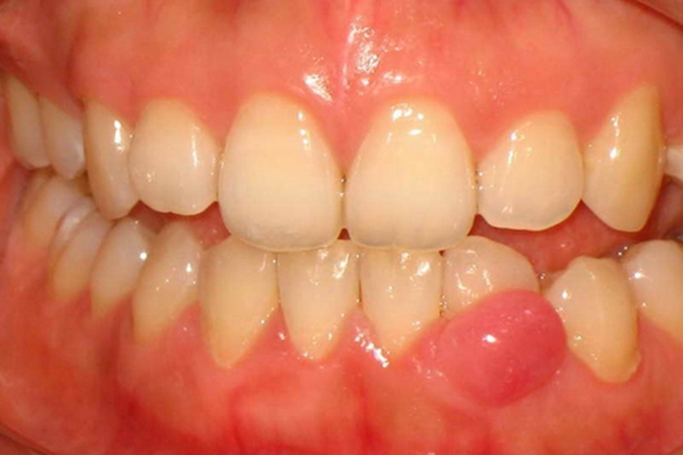 成年人牙龈囊肿图 成年人牙龈囊肿图