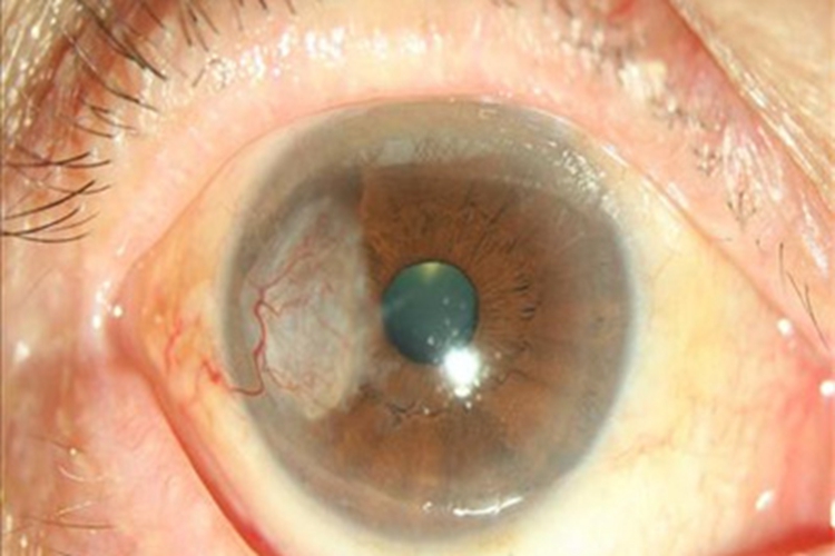 基质性角膜炎白斑图