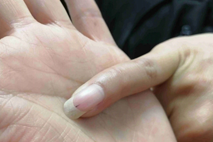 指甲裂片形出血指甲盖有小黑斑图