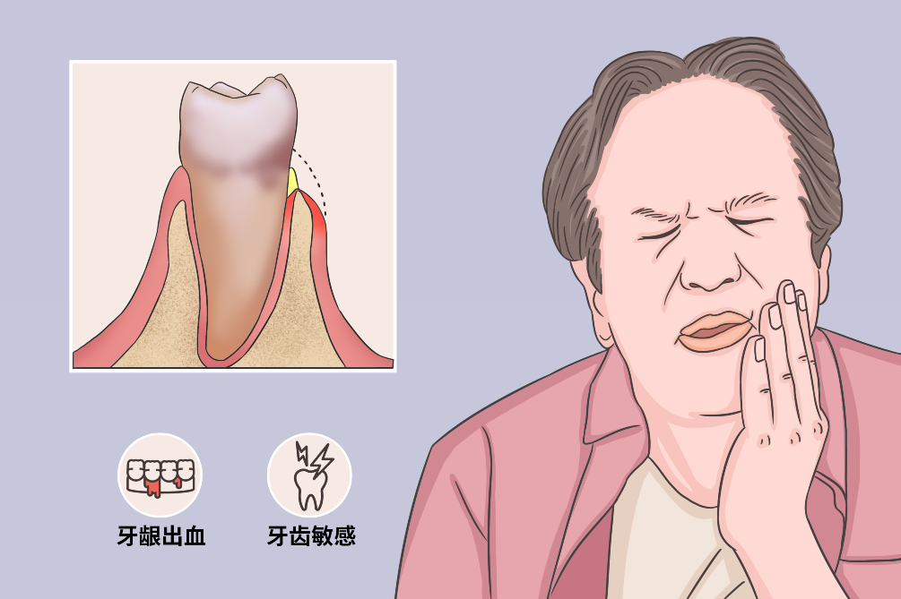 临床上牙周萎缩的主要表现是牙龈退缩,即龈缘向根方退缩,牙根暴露