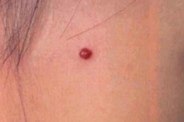 毛细血管瘤面部小红疙瘩图 毛细血管瘤面部小红疙瘩图