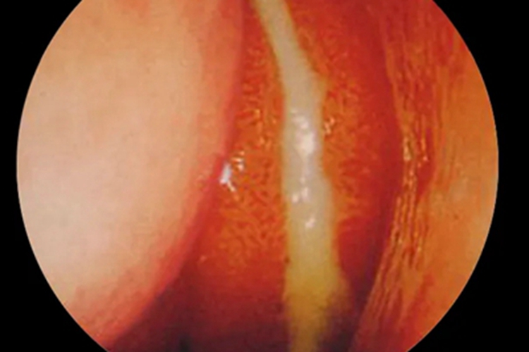 化脓性鼻窦炎水肿图