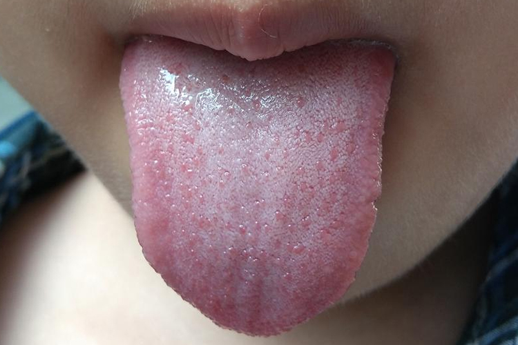 草莓舌舌头上有小红点图