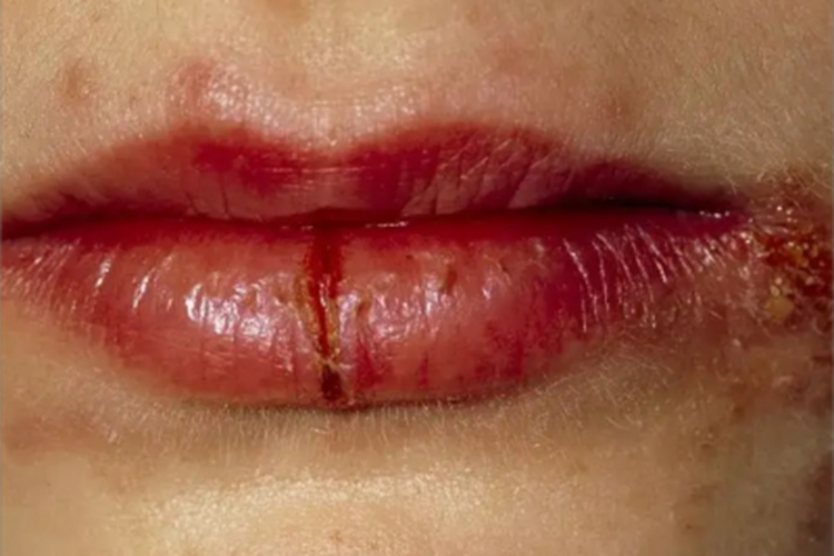 慢性唇炎嘴唇裂口图