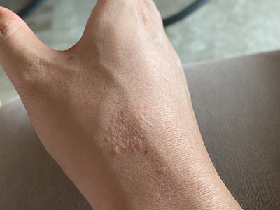 急性单纯性痒疹手背上长小疙瘩图