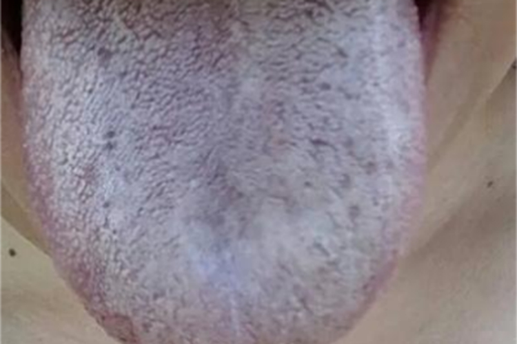 毛舌舌头上大面积发白图