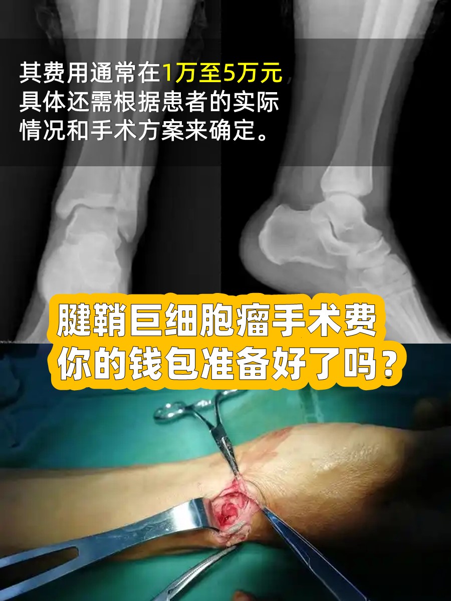 腱鞘巨细胞瘤手术费，你的钱包准备好了吗？