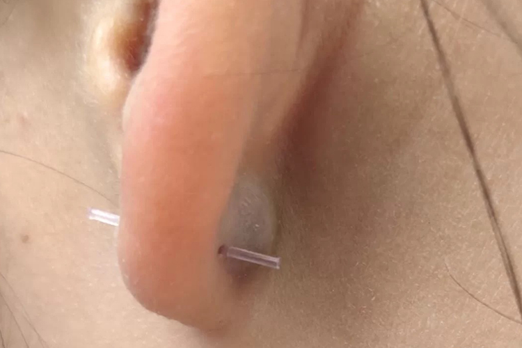 耳洞后面长了个血疱图 耳洞后面长了个血疱图