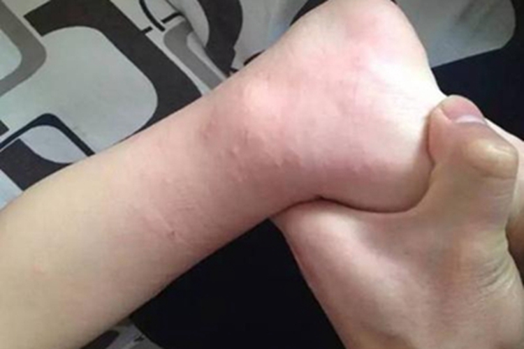 小儿丘疹性肢端皮炎脚踝症状图