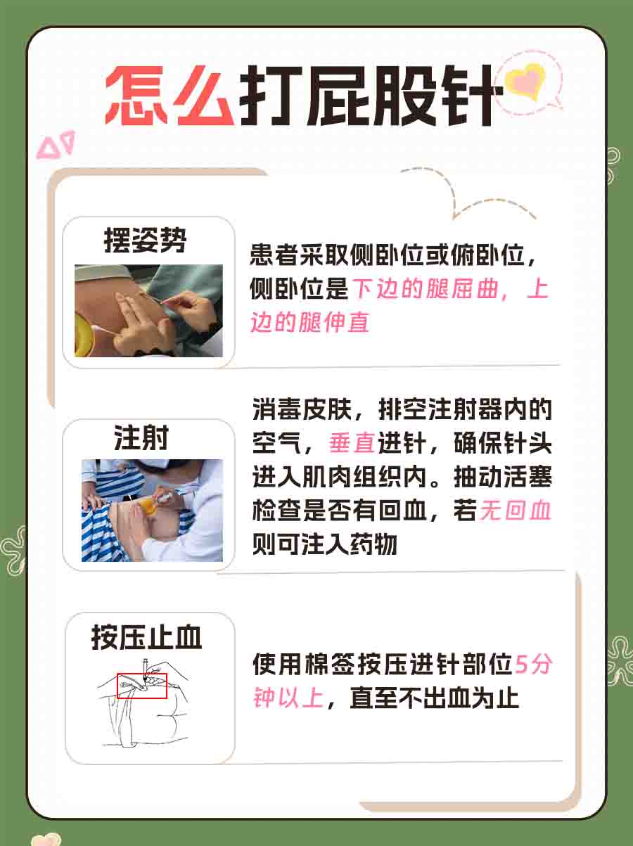 医生分享：一文看懂屁股针位置怎么定位？