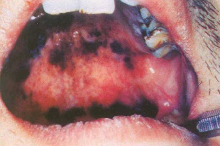 口腔上颚发黑图 口腔上颚发黑图