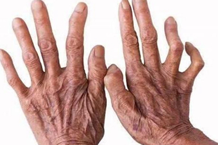 麻风病手指变形弯曲图