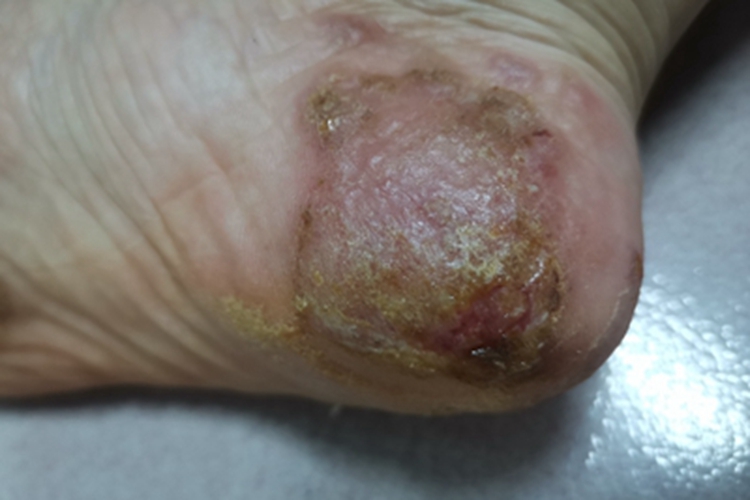 足癣脚后跟结痂图