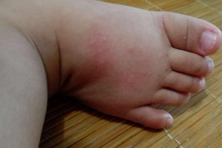 渗出型婴儿湿疹脚背红肿图