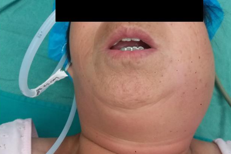 口腔蜂窝组织炎颌下肿胀图 口腔蜂窝组织炎颌下肿胀图