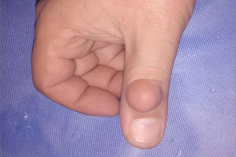 腱鞘纤维瘤手指疙瘩图 腱鞘纤维瘤手指疙瘩图