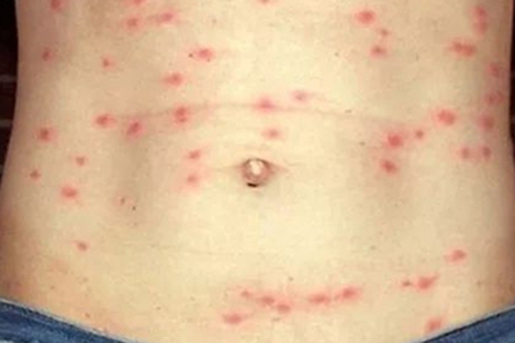 恙虫病腹部症状图