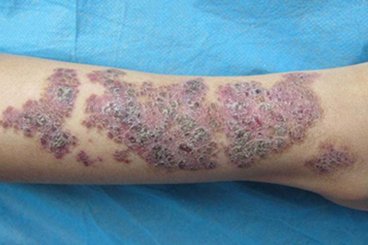 弥漫性躯体性血管角化瘤血痂图