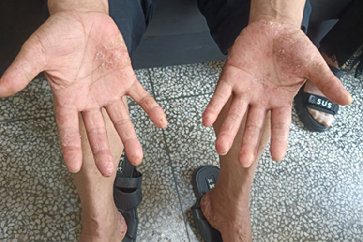 慢性湿疹手掌结痂图