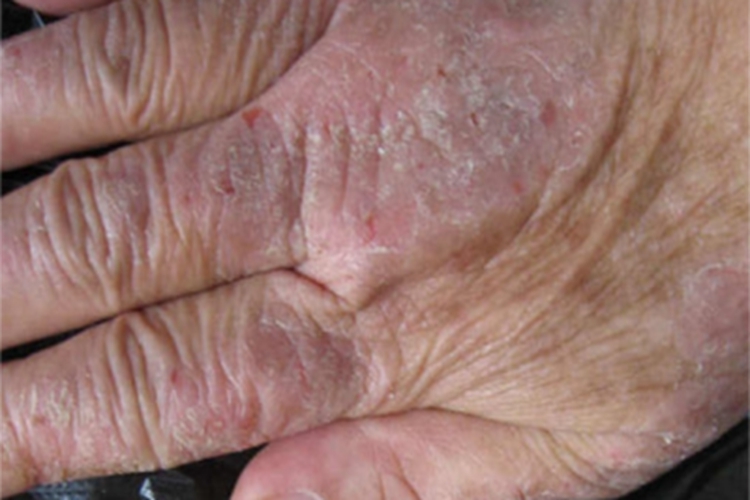 亚急性湿疹手部增厚图