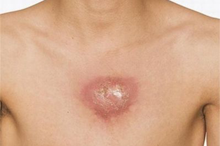 原发性皮肤结核综合征胸部症状图