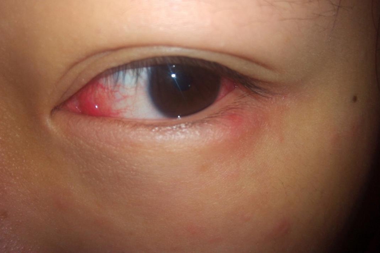 小孩眼睛发炎症状图片图片