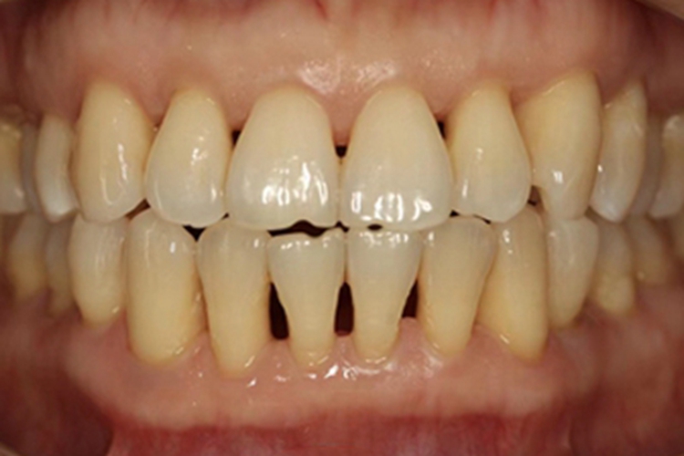 牙龈退缩下牙缝变得很大图 牙龈退缩下牙缝变得很大图
