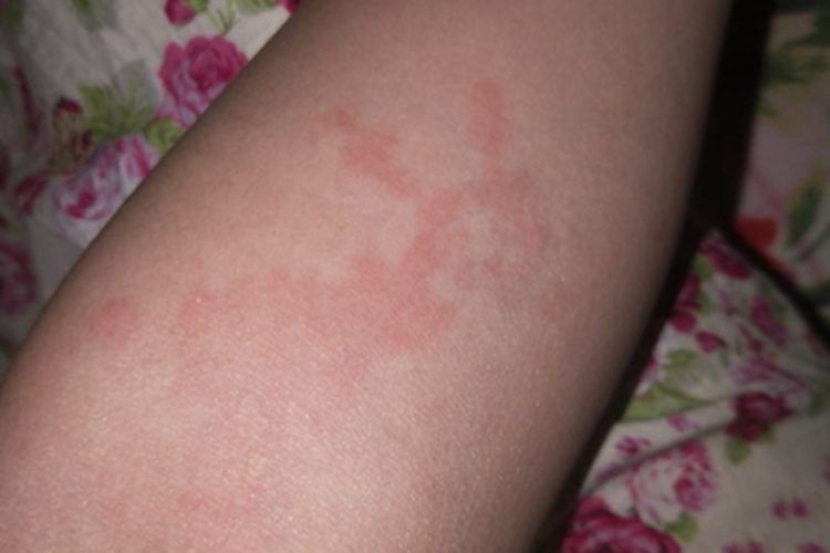 斑疹伤寒胳膊红斑图