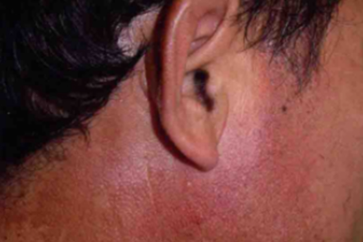 面颈部毛囊性红斑黑变病图