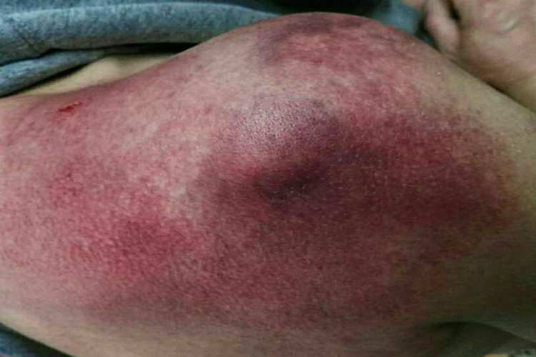 痧象呈紫黑色图