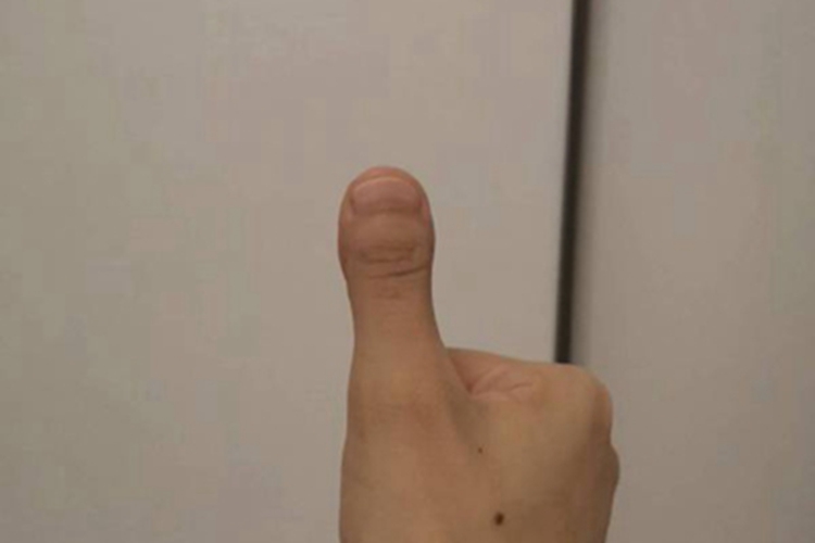 杵状指大拇指粗大图 杵状指大拇指粗大图