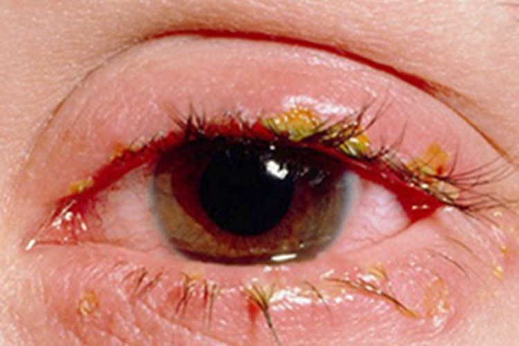 眼睑淋病眼部症状图