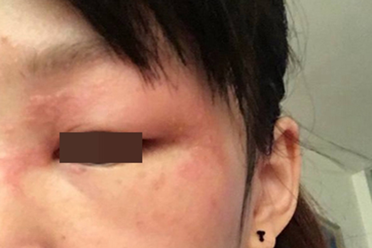 镍皮炎眼周症状图