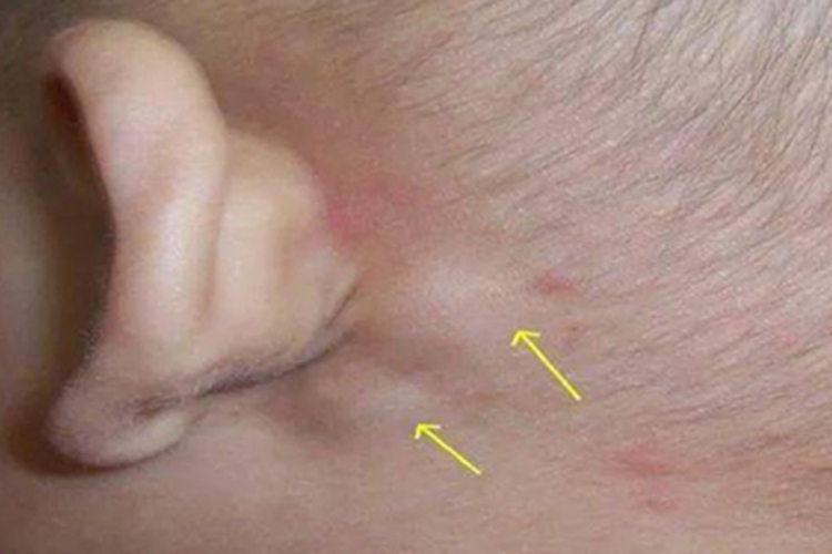 获得性风疹出疹期耳后有包块图 获得性风疹出疹期耳后有包块图