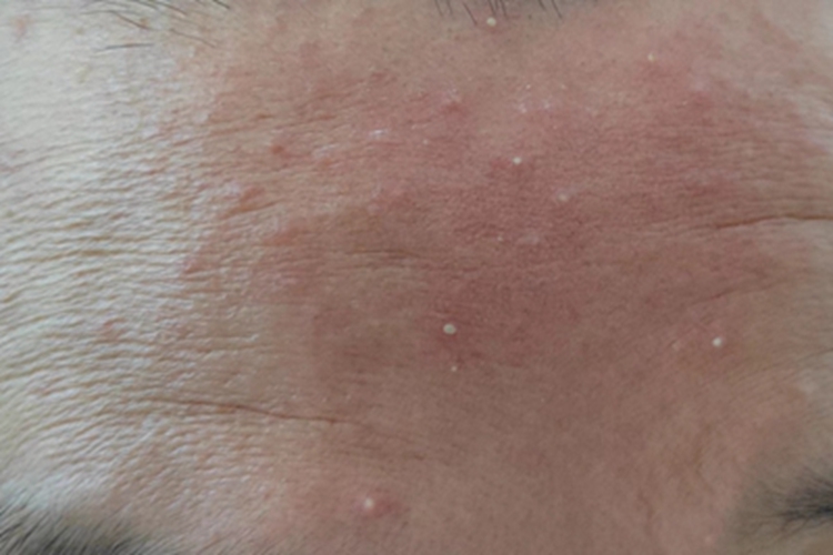 细菌性毛囊炎前额丘疹图 细菌性毛囊炎前额丘疹图