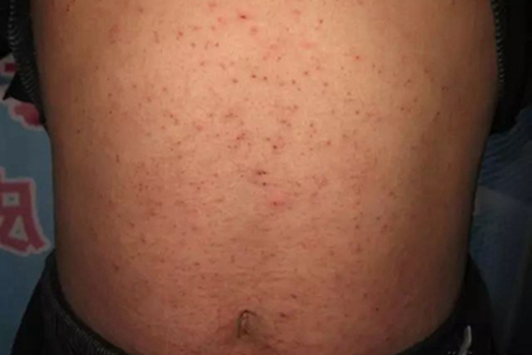 疥疮肚子上结好多痂图