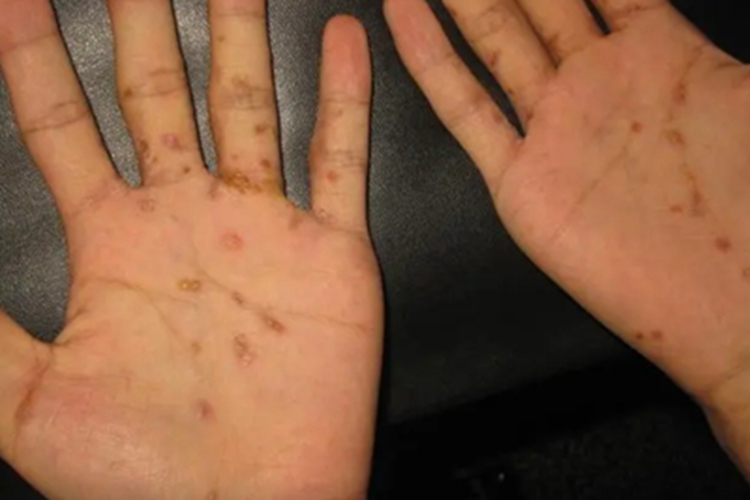 结痂性疥疮手掌小疙瘩图 结痂性疥疮手掌小疙瘩图