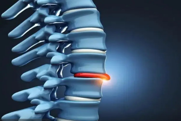 腰椎间盘突出图