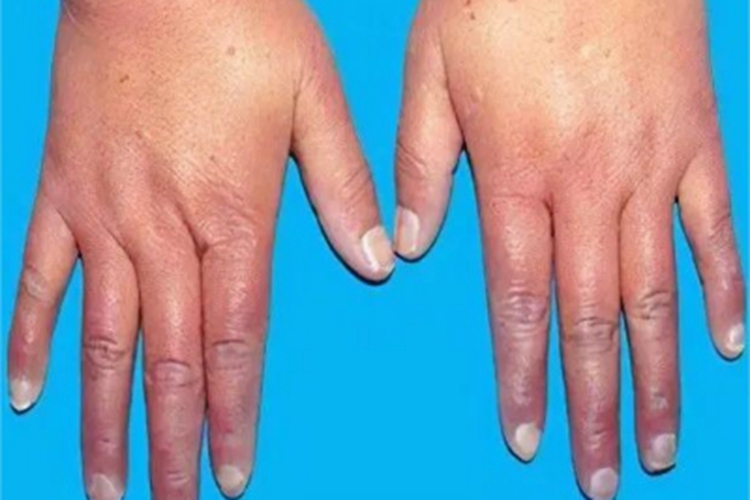 手足发绀症手指症状图 手足发绀症手指症状图