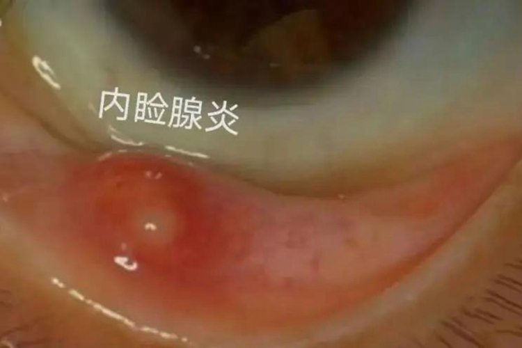 内眼角里的内睑腺炎图 内眼角里的内睑腺炎图